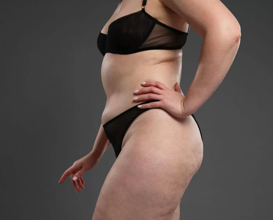 dieta para la celulitis